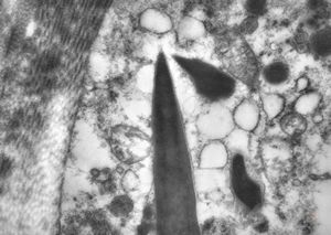 M, 43y. | myeloid leukemia … Auer bodies